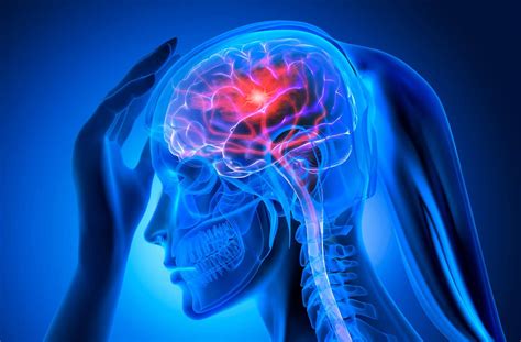 Aivohalvaus (stroke) .